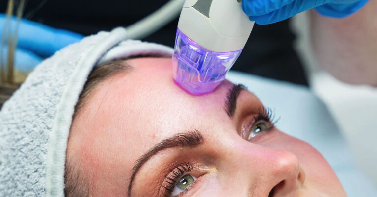 Microneedling with RF